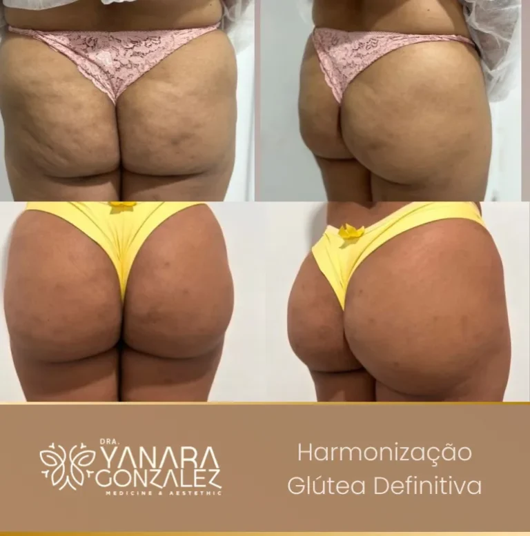 YG - antes e depois 1