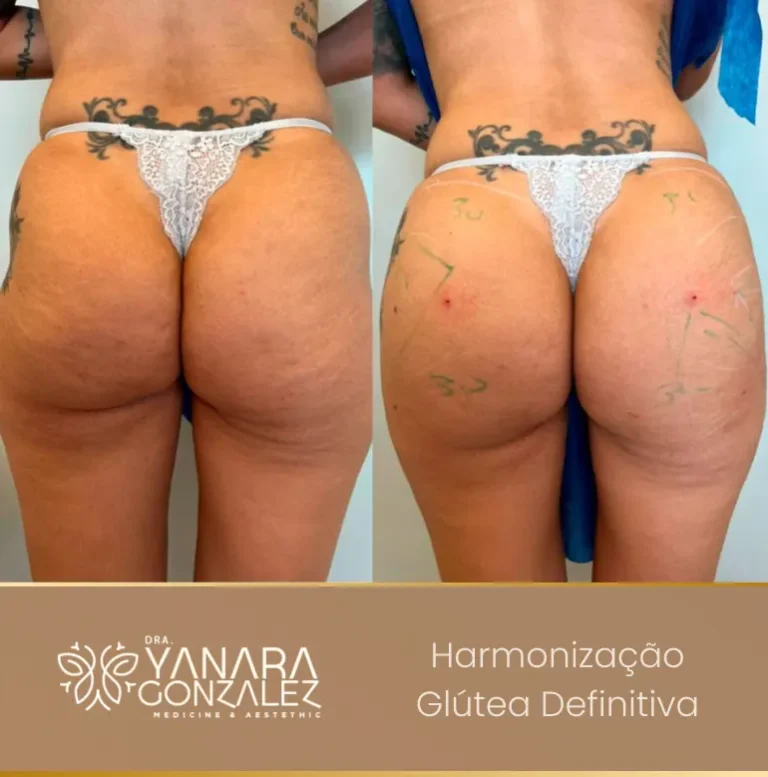 YG - antes e depois 2