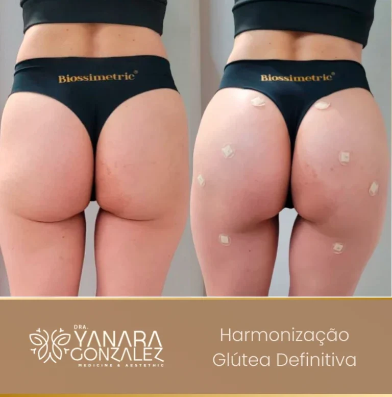 YG - antes e depois 3