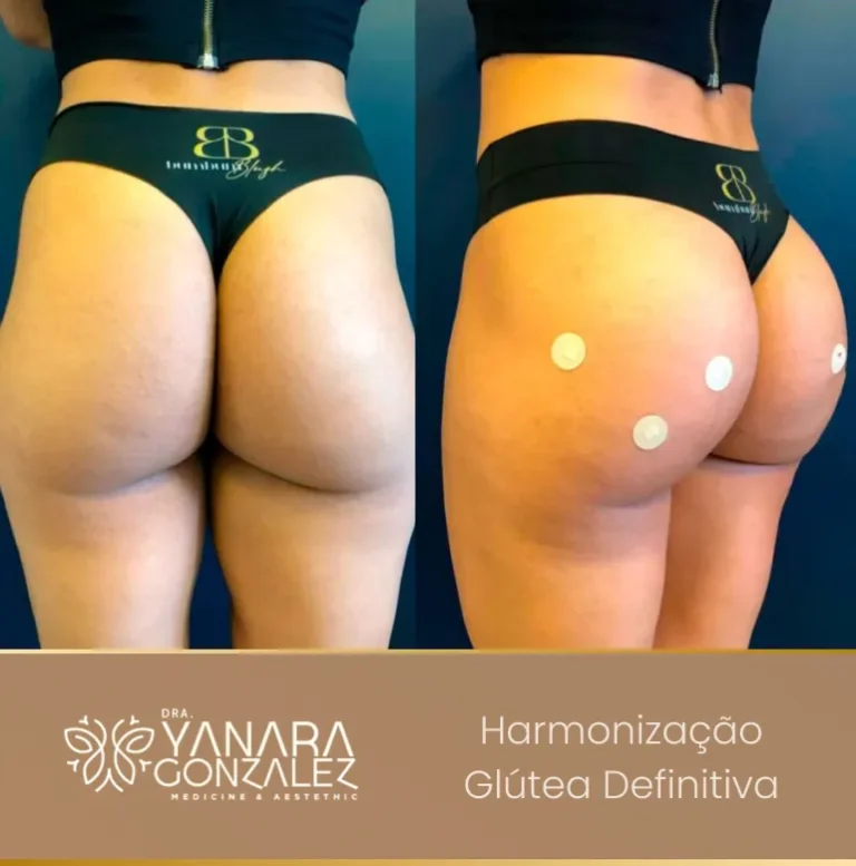 YG - antes e depois 4